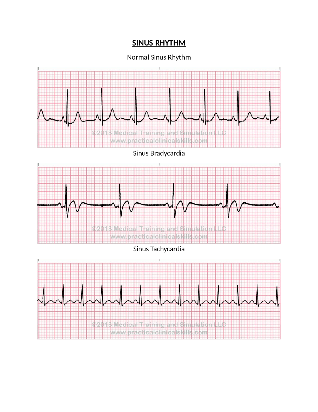 EKG Strips SINUS RHYTHM